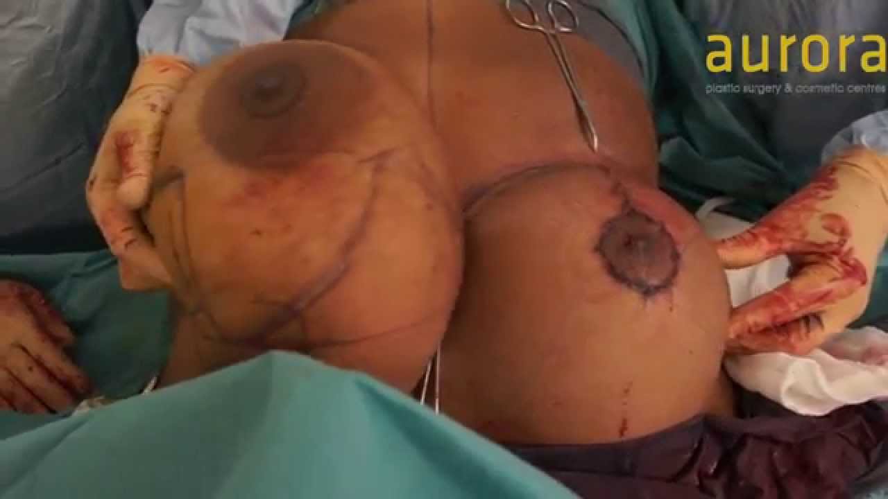 Breast Comparison at the half way point of Breast Reduction Surgery
