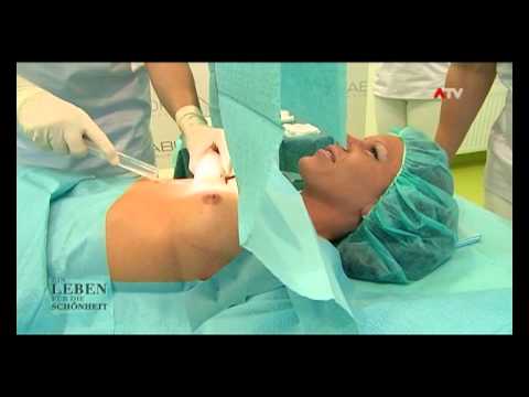 breast enlargement without surgery with Macrolane by Dr. Knabl, Nude Desi Actress