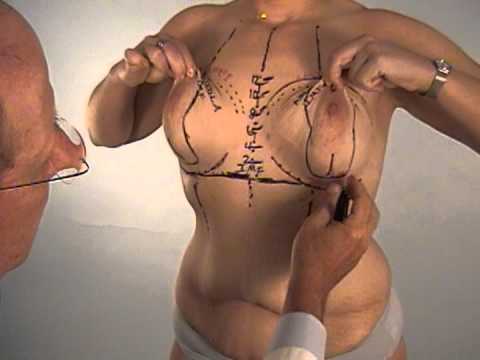 Dr. Scott Spear Performs a Breast Lift with Augmentation